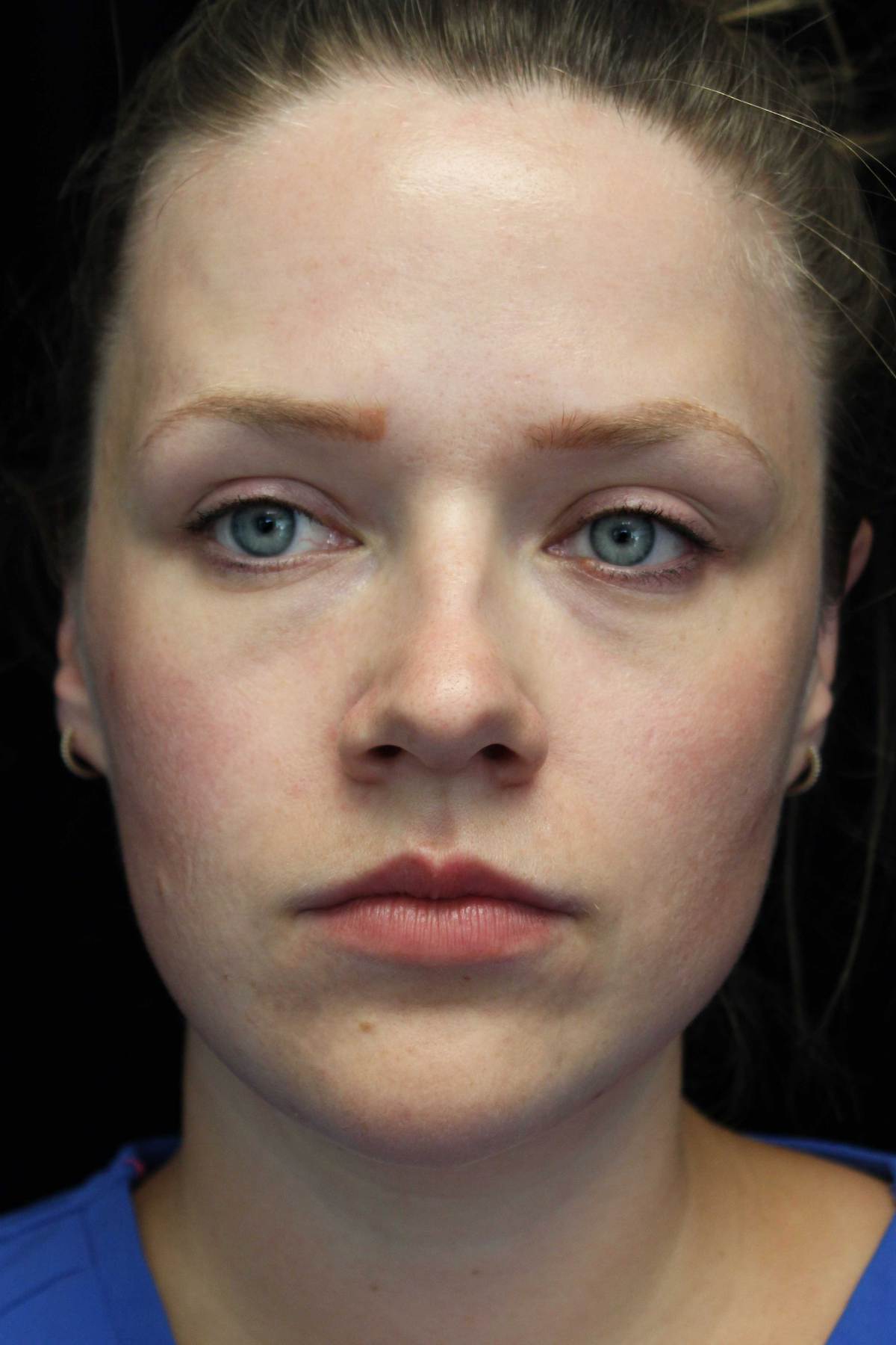 RHA Fillers Before & After Patient #19035