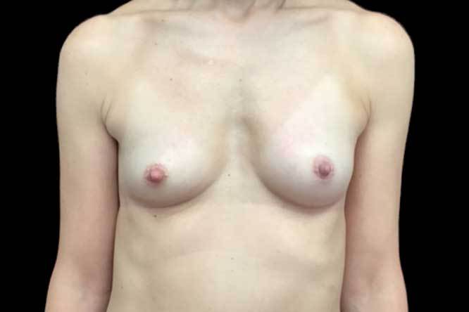 Breast Augmentation (Fat Transfer) Before & After Patient #19104