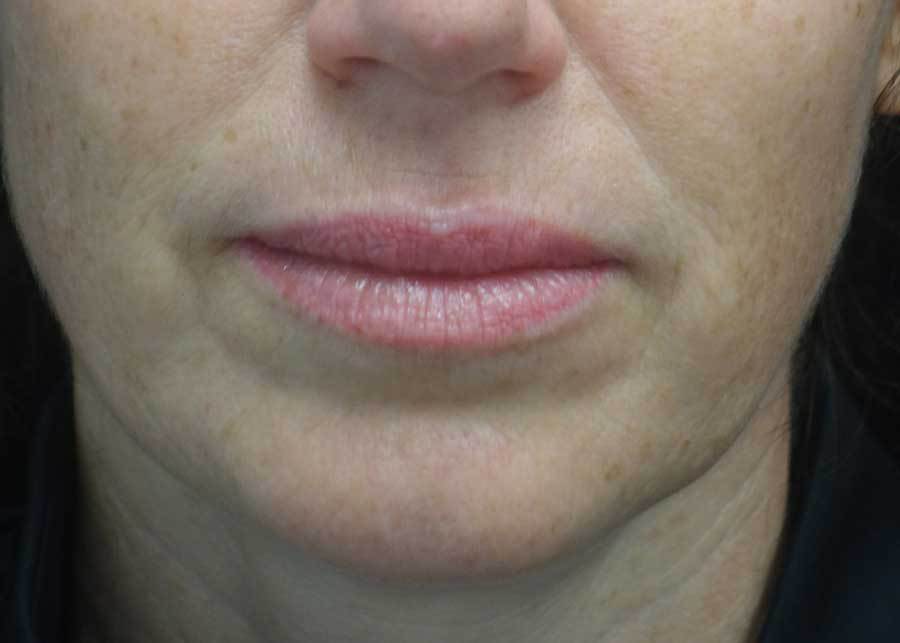Fat Transfer to Face Before & After Patient #19111