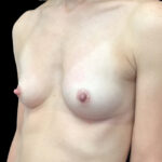 Breast Augmentation (Fat Transfer) Before & After Patient #19104