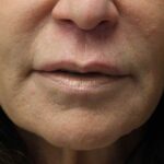 Lip Lift Before & After Patient #19134