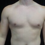 Gynecomastia Before & After Patient #19044
