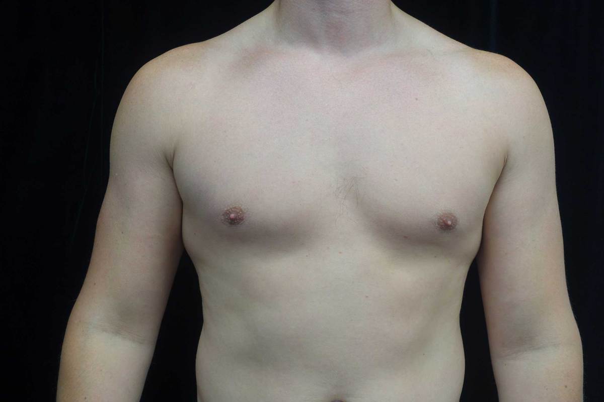 Gynecomastia Before & After Patient #19044
