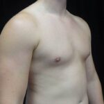 Gynecomastia Before & After Patient #19044