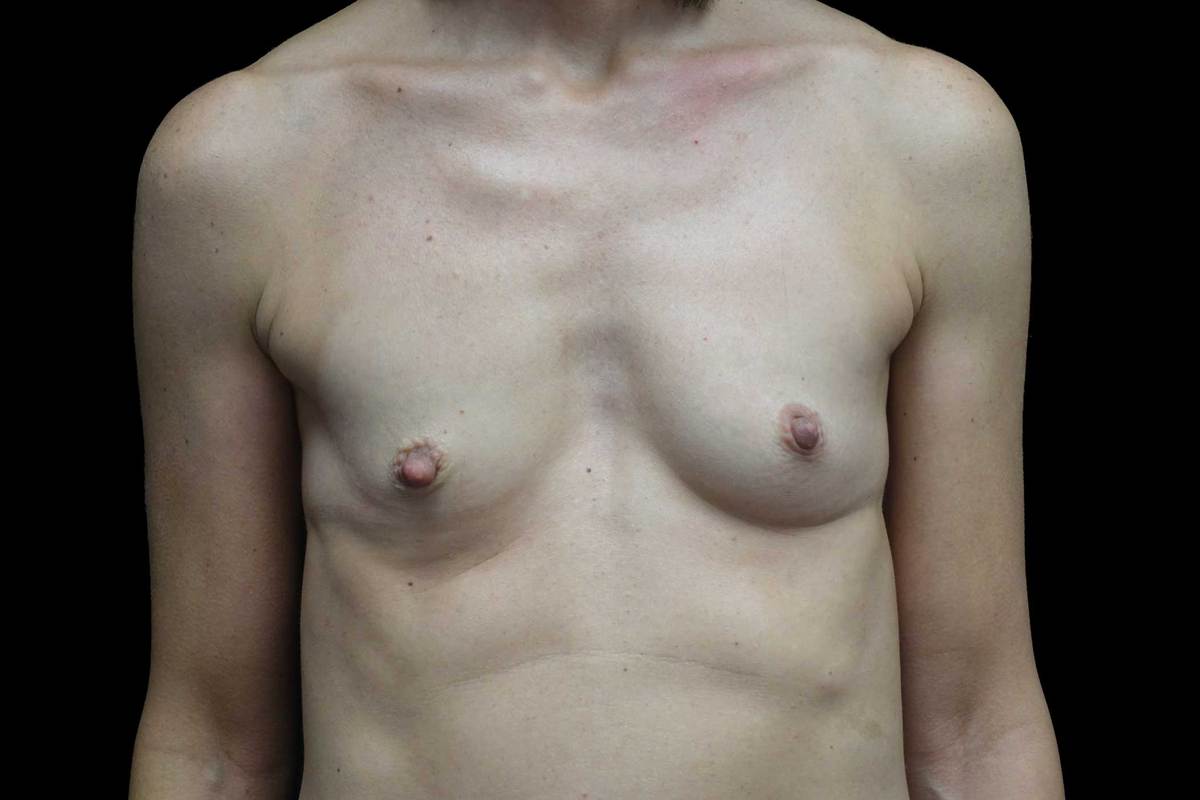 Breast Augmentation (Fat Transfer) Before & After Patient #19104