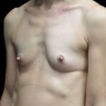 Breast Augmentation (Fat Transfer) Before & After Patient #19104