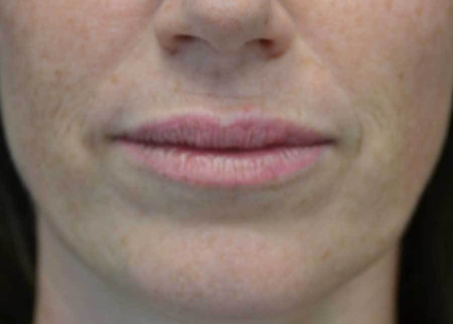 Fat Transfer to Face Before & After Patient #19111