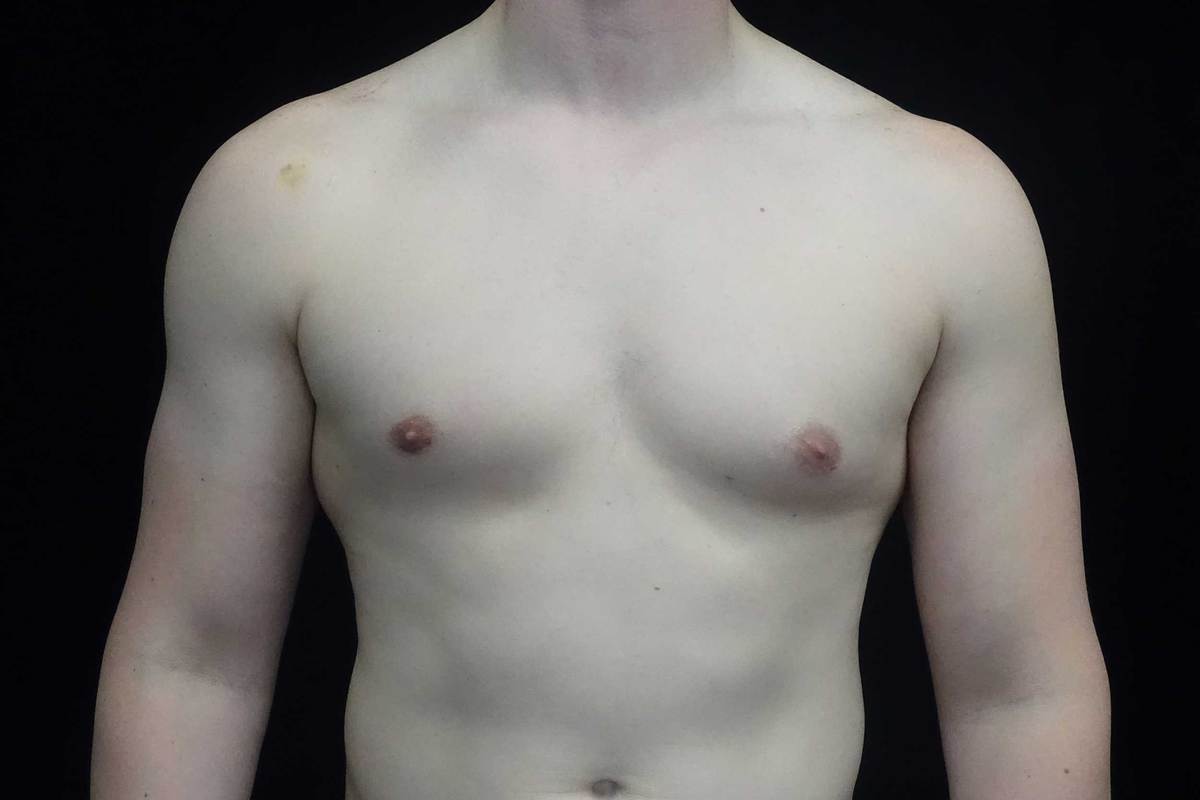 Gynecomastia Before & After Patient #19044