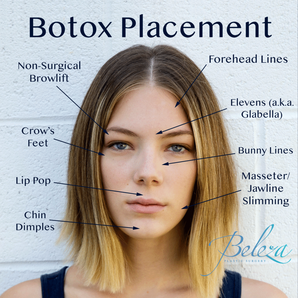 botox placement