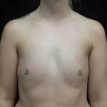 Breast Augmentation (Implants) Before & After Patient #19149