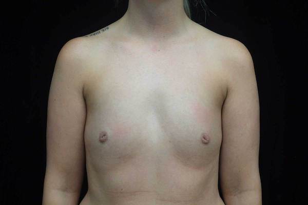Breast Augmentation (Implants) Before & After Patient #19149