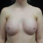 Breast Augmentation (Implants) Before & After Patient #19149