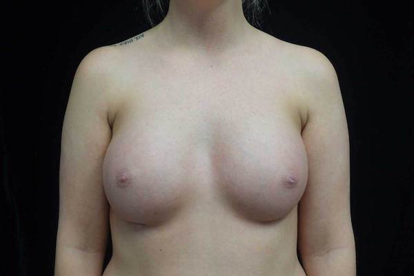 Breast Augmentation (Implants) Before & After Patient #19149