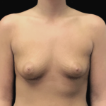 Breast Augmentation (Implants) Before & After Patient #19204