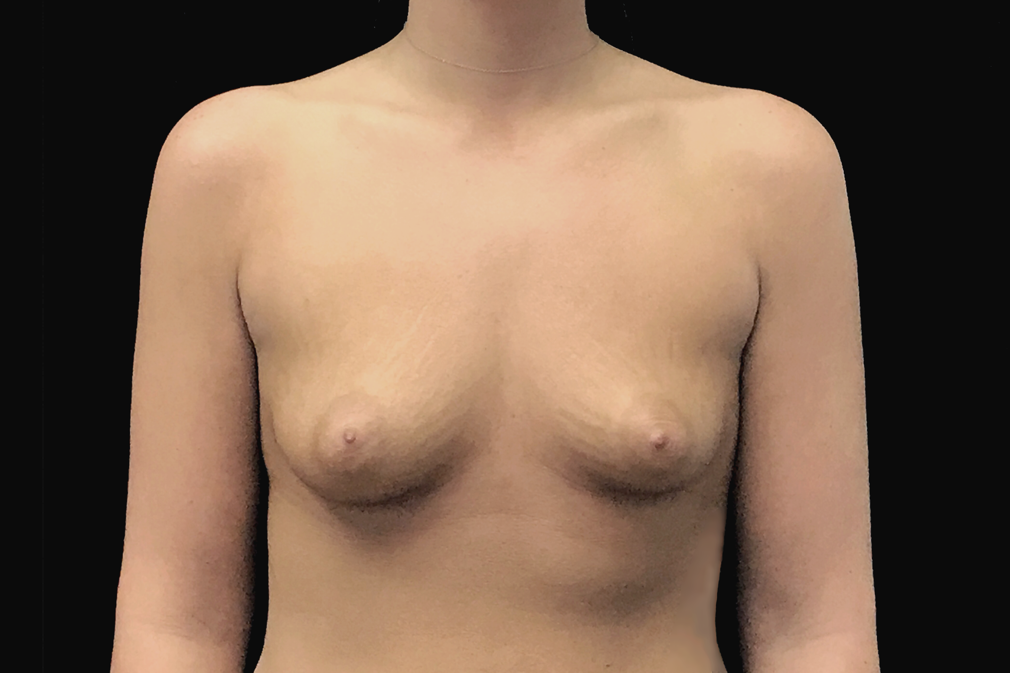 Breast Augmentation (Implants) Before & After Patient #19204