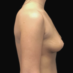Breast Augmentation (Implants) Before & After Patient #19204