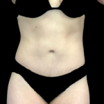 Tummy Tuck Before & After Patient #19200