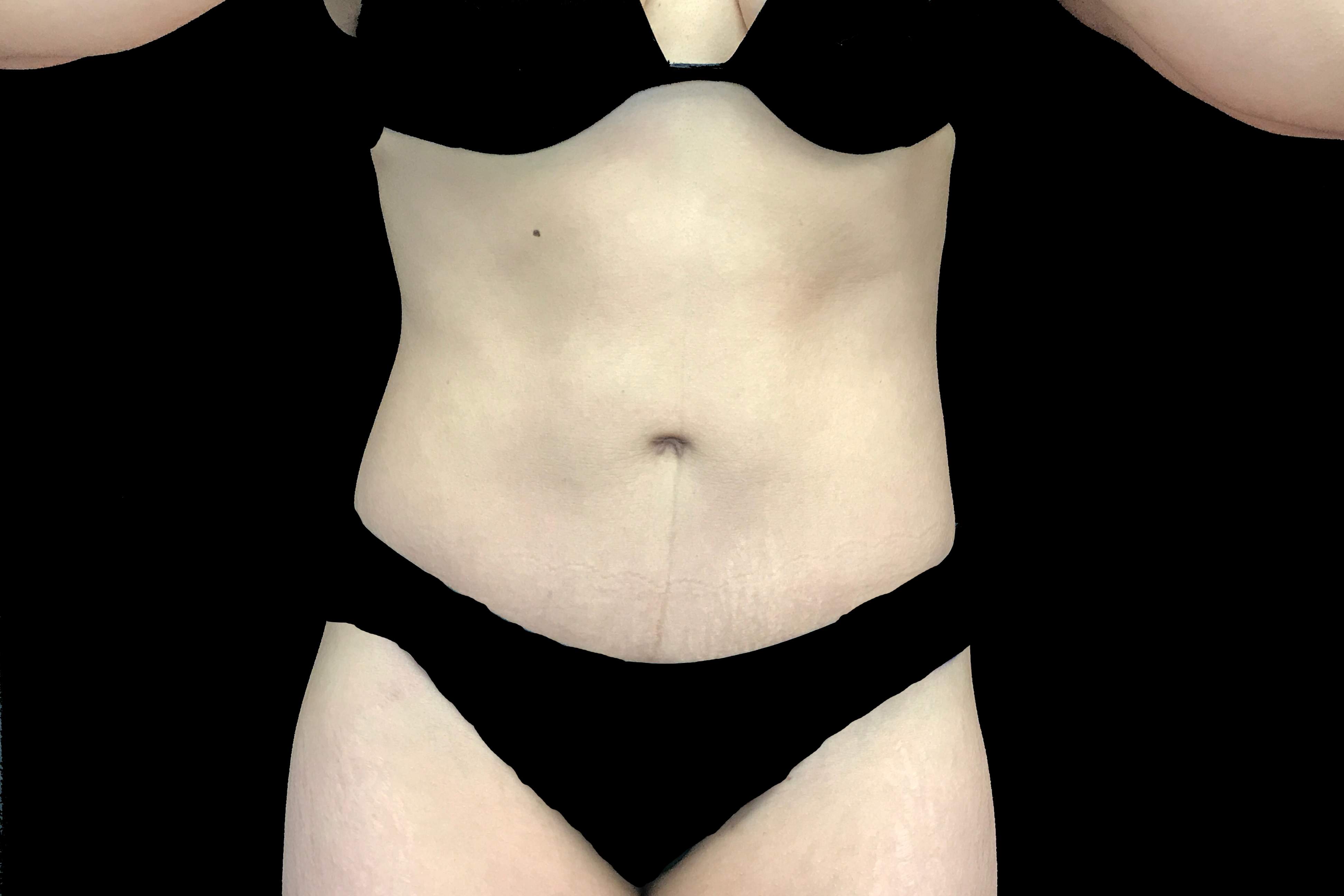 Tummy Tuck Before & After Patient #19200