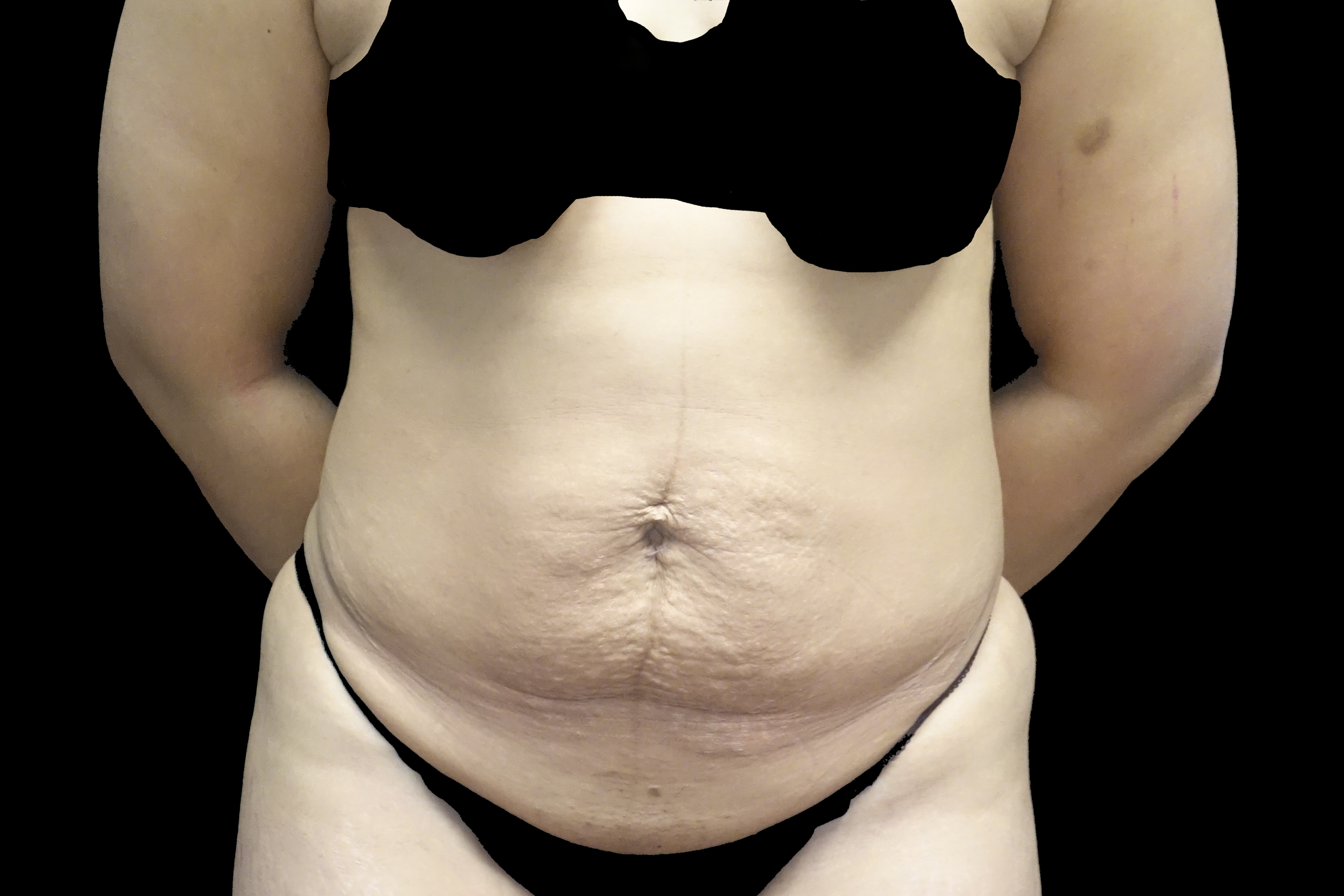 Tummy Tuck Before & After Patient #19200