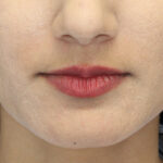 Lip Augmentation - Fillers Before & After Patient #19214