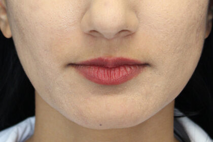Lip Augmentation - Fillers Before & After Patient #19214