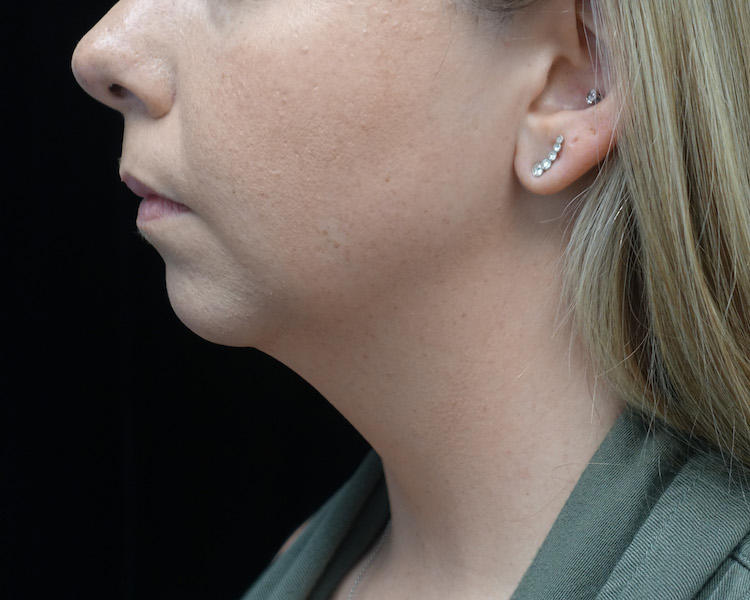 Chin Implants (Augmentation) Before & After Patient #19234