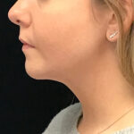 Chin Implants (Augmentation) Before & After Patient #19234