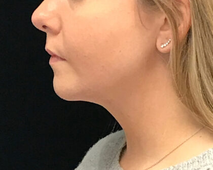 Chin Implants Before & After Patient #19234