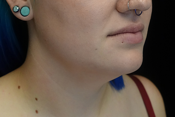 CoolSculpting Before & After Patient #19264