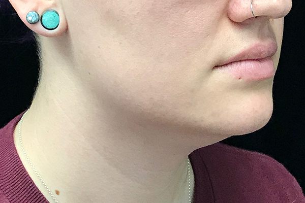 CoolSculpting Before & After Patient #19264