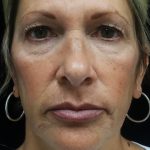 Lip Augmentation - Fillers Before & After Patient #19299