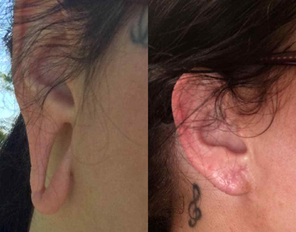 Ear Lobe Repair Treatment In Dlf Phase 4