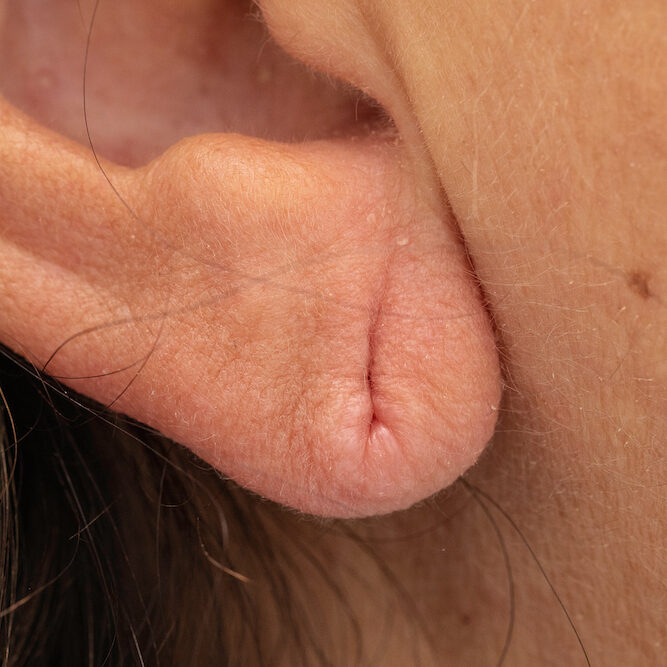 5 Questions People Ask Before an Earlobe Reconstruction Surgery