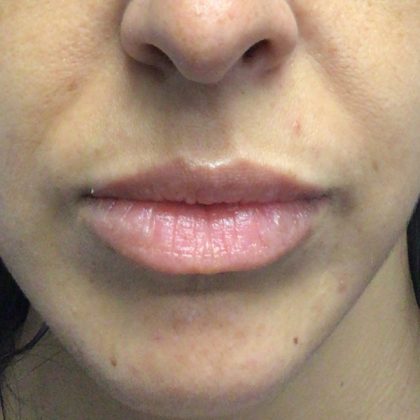 Lip Augmentation - Fillers Before & After Patient #19317