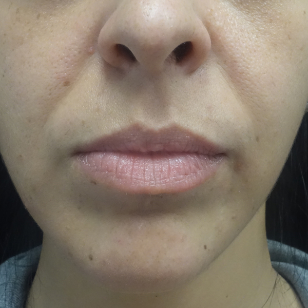 Lip Augmentation - Fillers Before & After Patient #19317