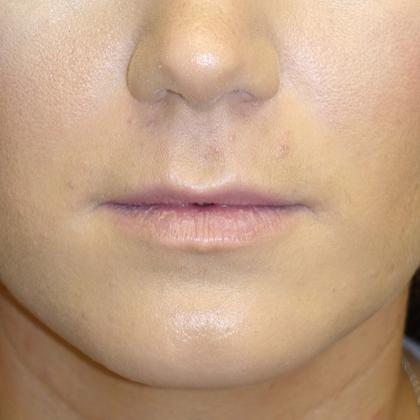 Lip Lift Before & After Patient #19390