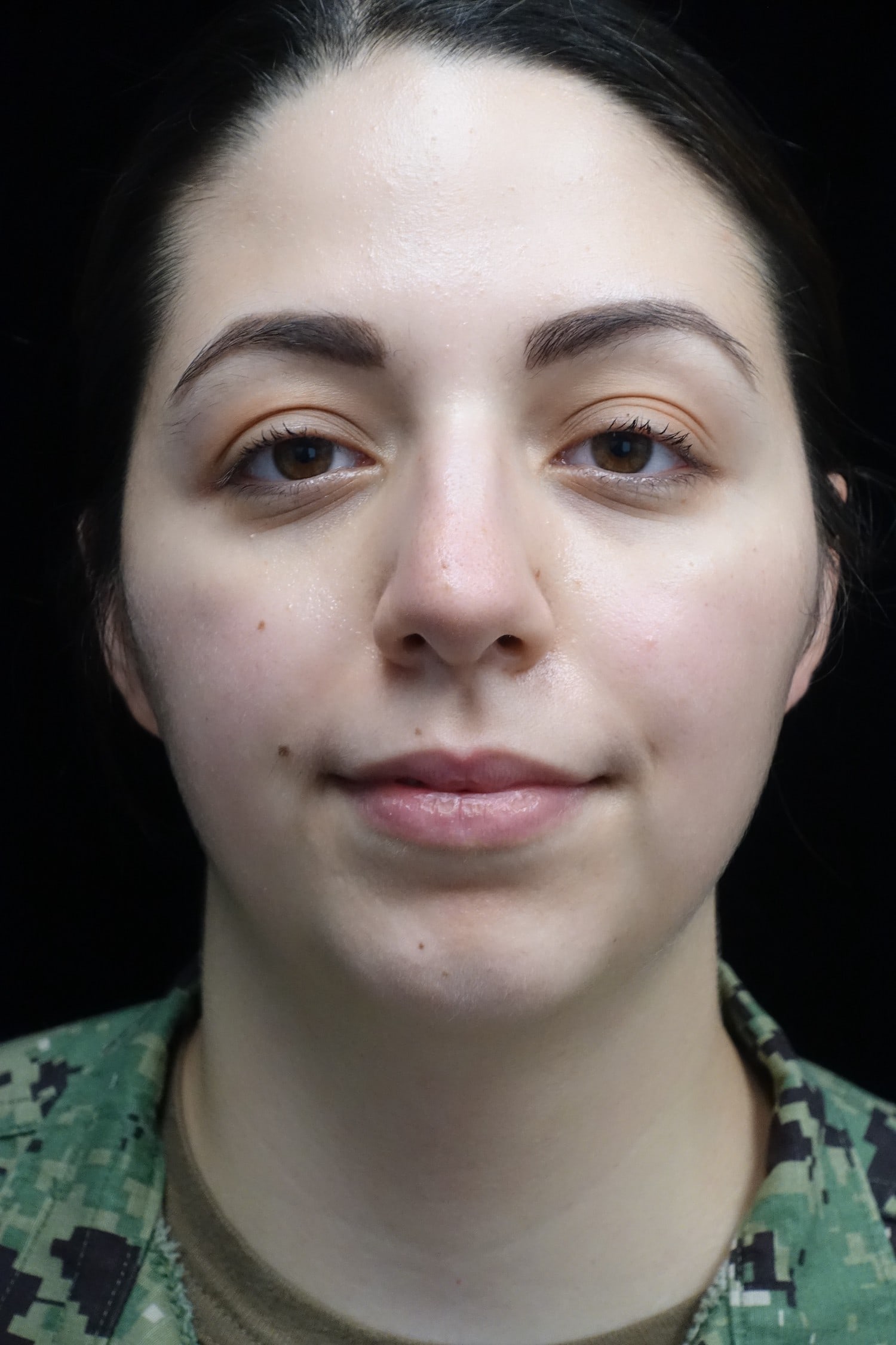Chin Implants (Augmentation) Before & After Patient #19461