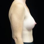 Breast Augmentation (Implants) Before & After Patient #19429
