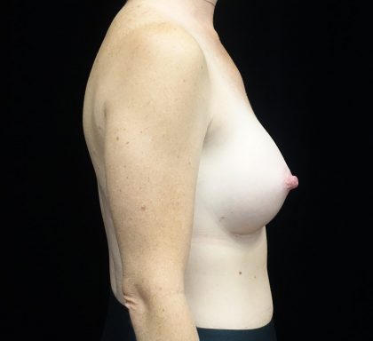 Breast Augmentation (Implants) Before & After Patient #19429