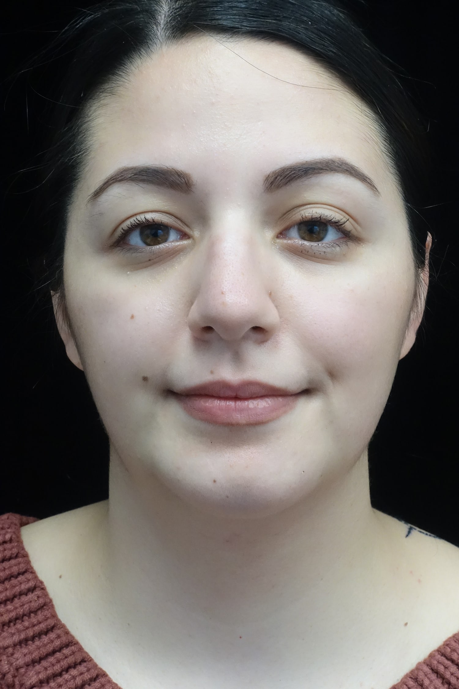 Chin Implants (Augmentation) Before & After Patient #19461