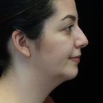 Chin Implants (Augmentation) Before & After Patient #19461
