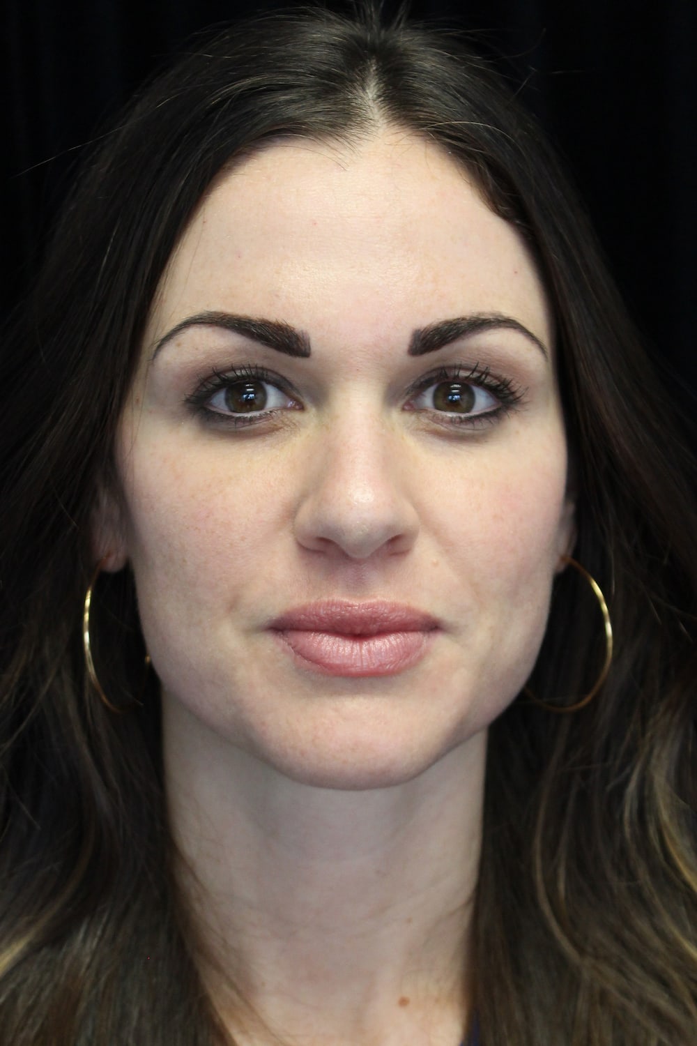 Lip Augmentation - Fillers Before & After Patient #19442