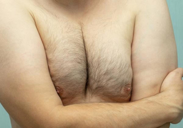 chest liposuction Pittsburgh