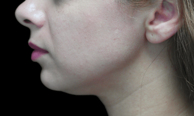 Fillers & Injectables Before & After Patient #19469