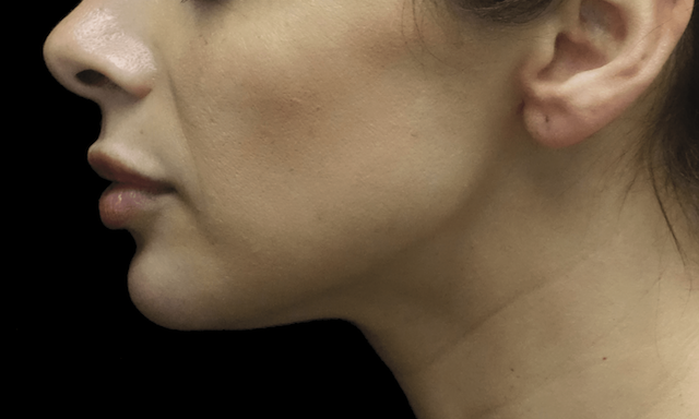 Fillers & Injectables Before & After Patient #19469
