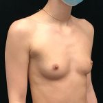 Breast Augmentation (Implants) Before & After Patient #19394