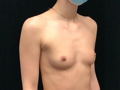Breast Augmentation (Implants) Before & After Patient #19394