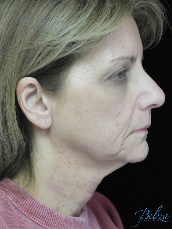 Dermabrasion Before & After Patient #19544