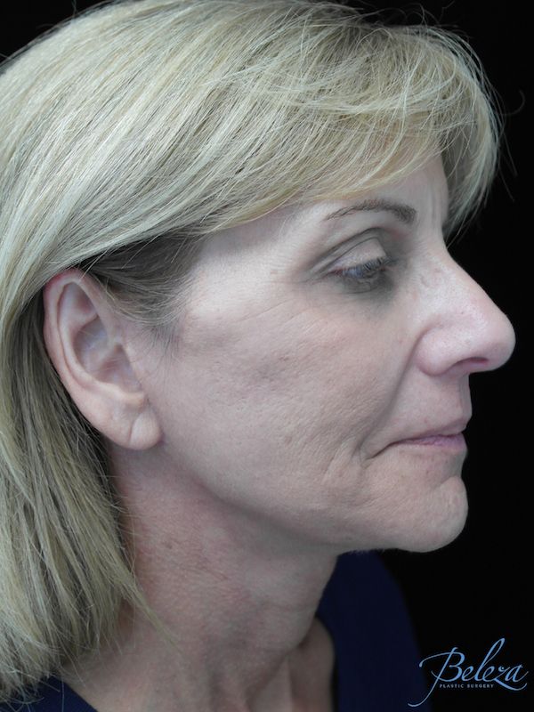 Dermabrasion Before & After Patient #19544