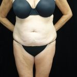 Tummy Tuck Before & After Patient #19541